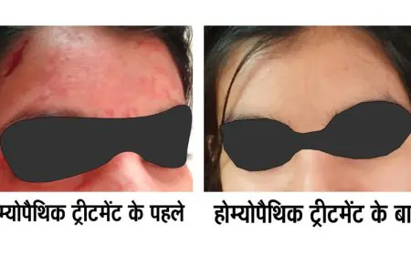 Rare disease Blood-Sweating Disorder Successfully Treated with Advanced Homeopathy – Dr AK dwivedi