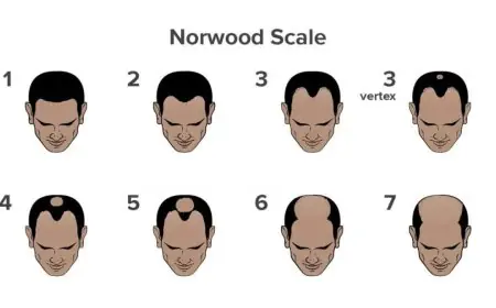 What is Causing Your Hair Fall? Take This Scientifically Backed Hair Loss Quiz