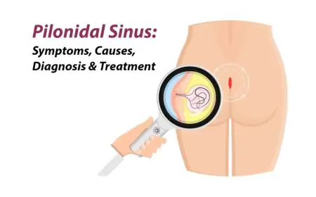 Advanced Pilonidal Treatment in Thrissur, Kerala – Dr. Raviram S.