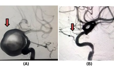 Pioneering Neurointerventional Excellence at Jehangir Hospital