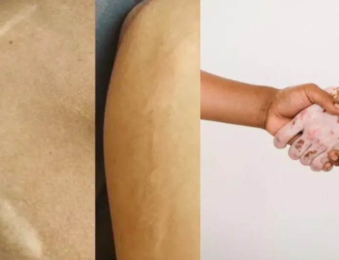 Scar and Vitiligo Treatment in Mumbai, Vitiligo and Scar Treatment Clinic in Mumbai – BrowMaster