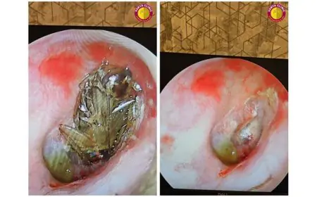 Cockroach in Ear: Dr. Purodha Prasad Saves Delhi Patient in Emergency ENT Case